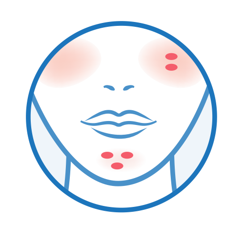 ニキビ（赤み、でこぼこ）・酒さ